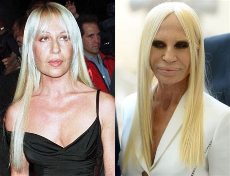 donatella versace before after surgery|donatella versace plastic surgery 2022.